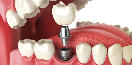 dental implants