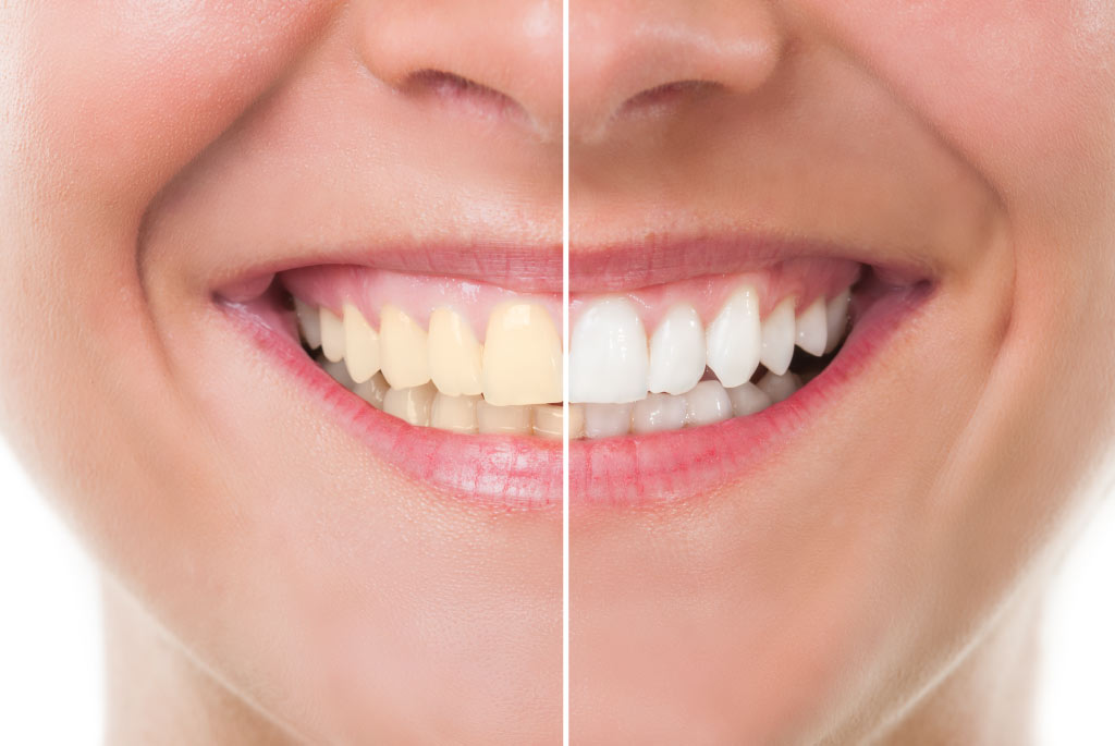 woman's smile side by side image yellow teeth on left and white teeth on right, before and after teeth whitening