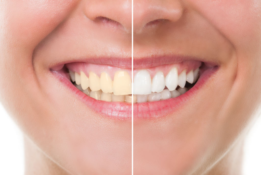 Why Do Teeth Turn Yellow Teeth Whitening Reen Chung DDS