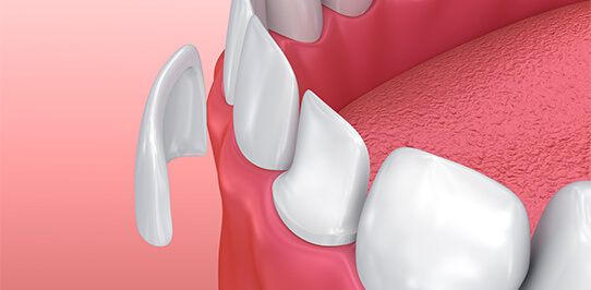 illustration of a porcelain veneer being placed on a prepared tooth