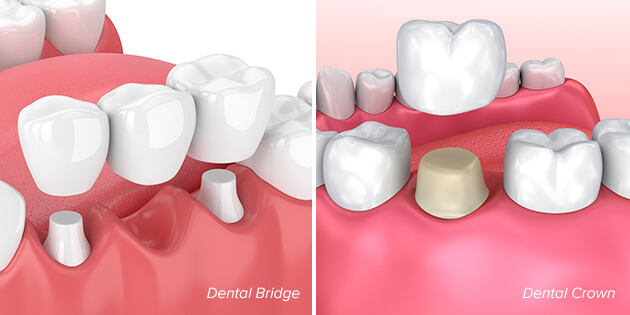 illustration showing an example of a dental bridge and a dental crown