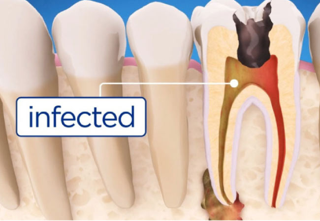 illustration of an infected tooth needing root canal therapy