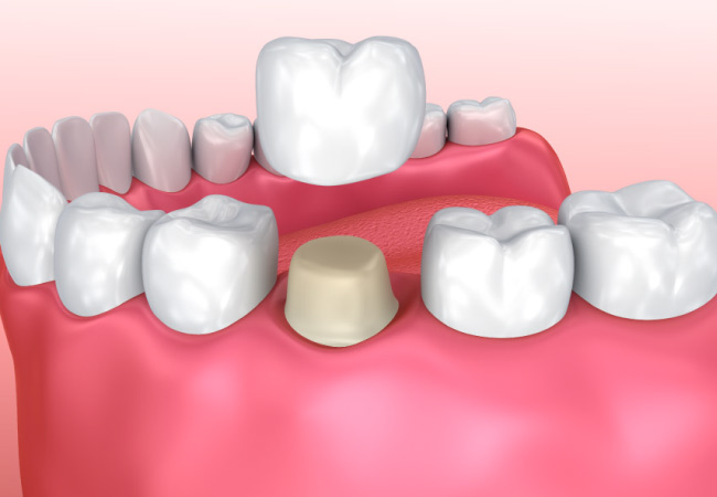 dental crown model