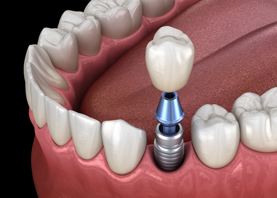 dental implants in Seattle,W A