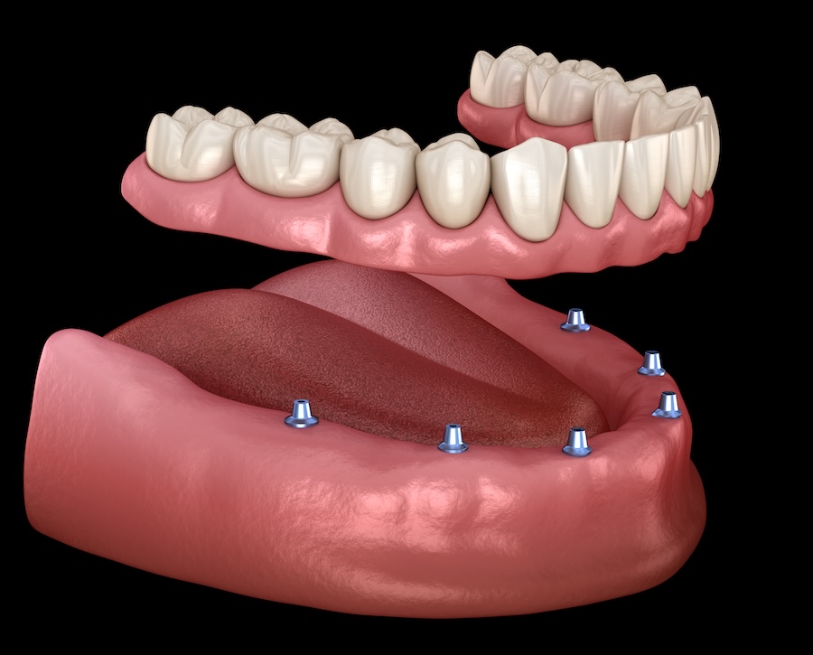 overdenture, implant supported denture, all on 4, all on 6, all on x denture