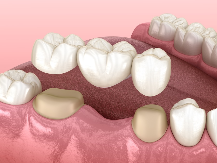 dental bridge dental crown