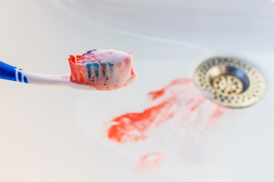 bleeding gums, periodontal therapy, gum disease